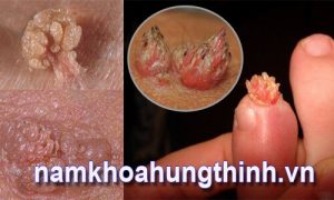 sùi mào gà lây qua những đường nào