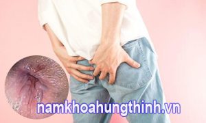 bệnh trĩ có lây không