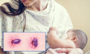 bệnh trĩ sau khi sinh