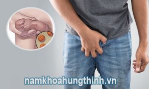 Sùi mào gà có gây ngứa không