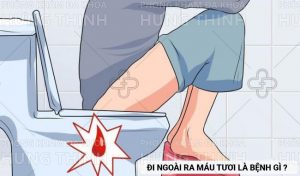 Đi ngoài ra máu tươi là bệnh gì