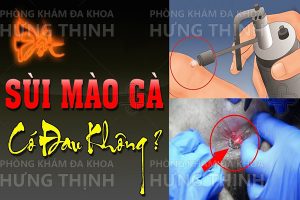 Đốt điện sùi mào gà như thế nào?