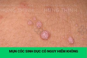 Mụn cóc sinh dục có nguy hiểm không