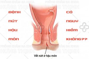 Bệnh nứt kẽ hậu môn có nguy hiểm không