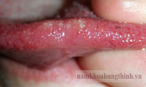 cuống lưỡi nổi mụn đỏ là bệnh gì