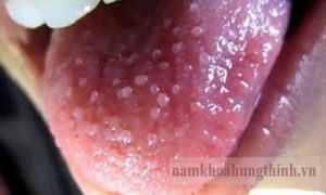 cuống lưỡi nổi hạt đỏ có thể do sùi mào gà ở miệng