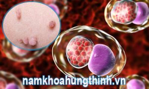 sùi mào gà có nguy hiểm không