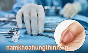 chảy nước vàng sau khi cắt bao quy đầu