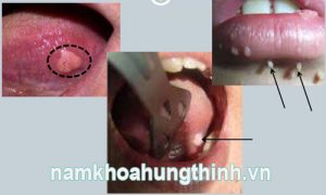 điều trị sùi mào gà ở miệng