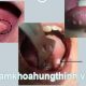 điều trị sùi mào gà ở miệng