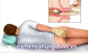 khám trĩ ở khoa nào