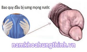 sau khi cắt bao quy đầu bị mọng nước