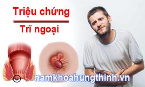 triệu chứng của bệnh trĩ ngoại