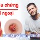 triệu chứng của bệnh trĩ ngoại