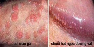 phân biệt chuối hạt ngọc dương vật và sùi mào gà