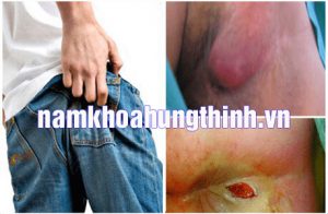 khám và chữa rò hậu môn ở đâu