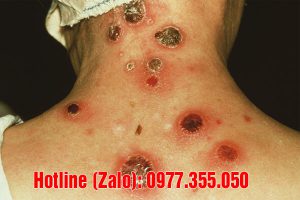 Bệnh giang mai co tái phát lại không