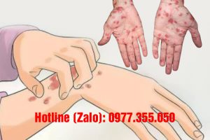 Bệnh giang mai có gây ngứa không