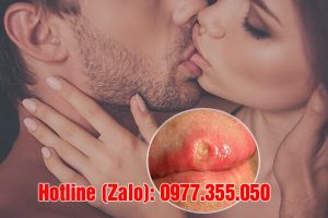 giang mai có lây qua đường nước bọt không